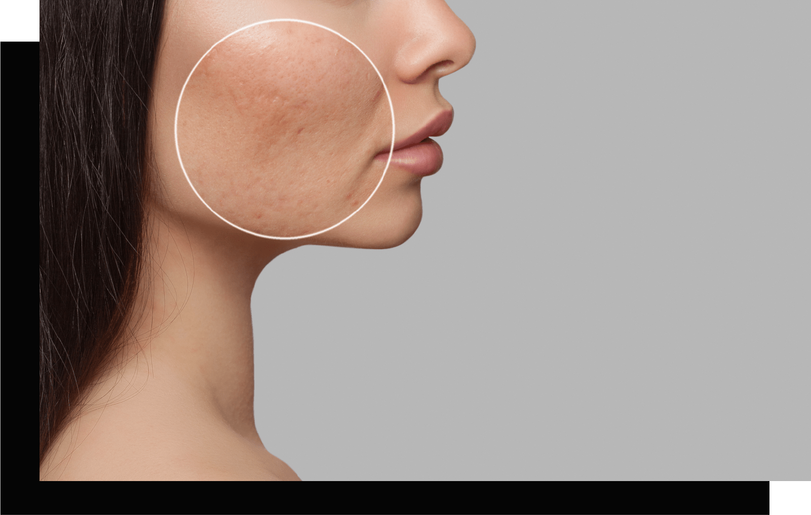 Scarring Laser Skin and Body