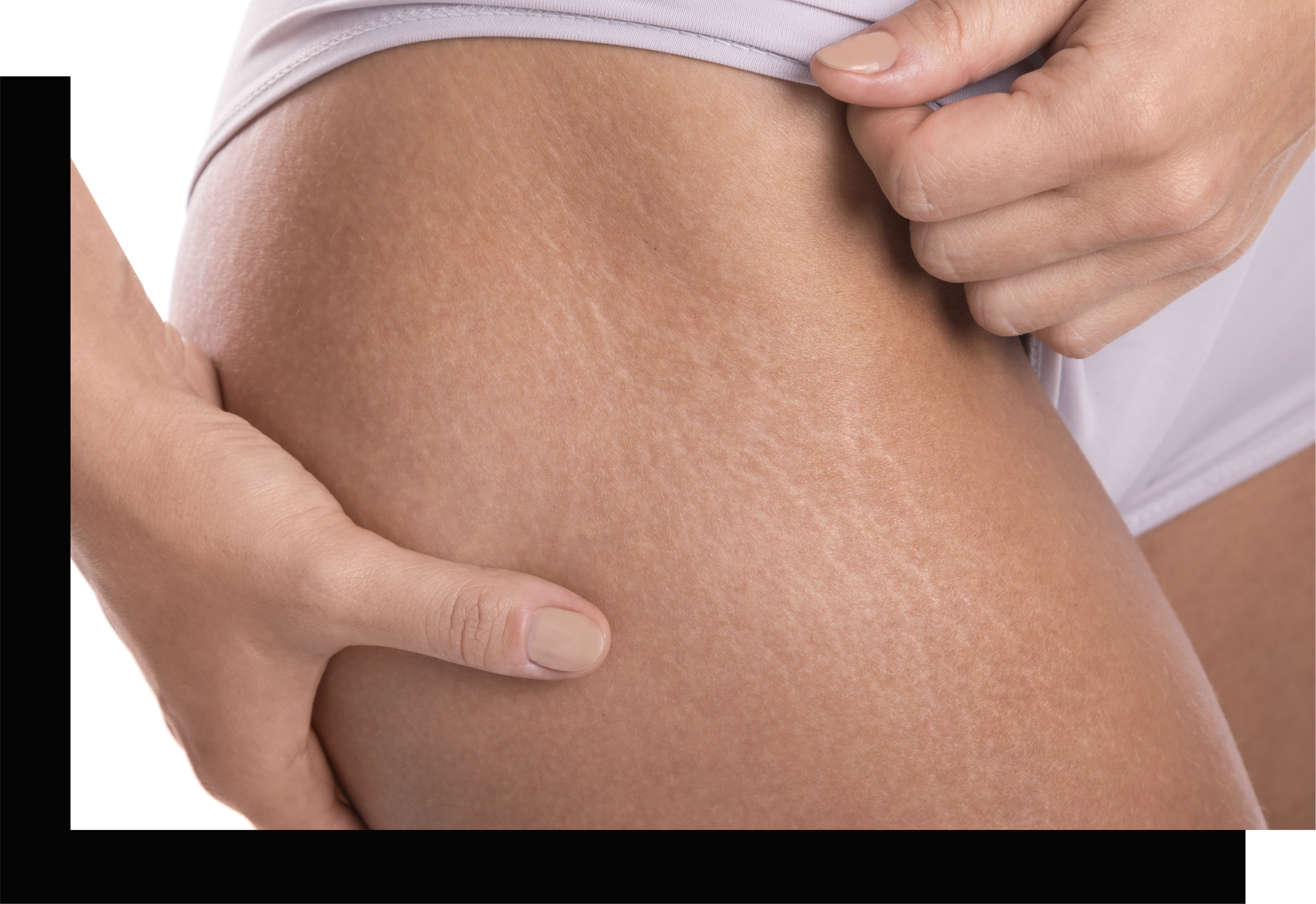 Stretch marks/micro fissures between two surface breaking portions of